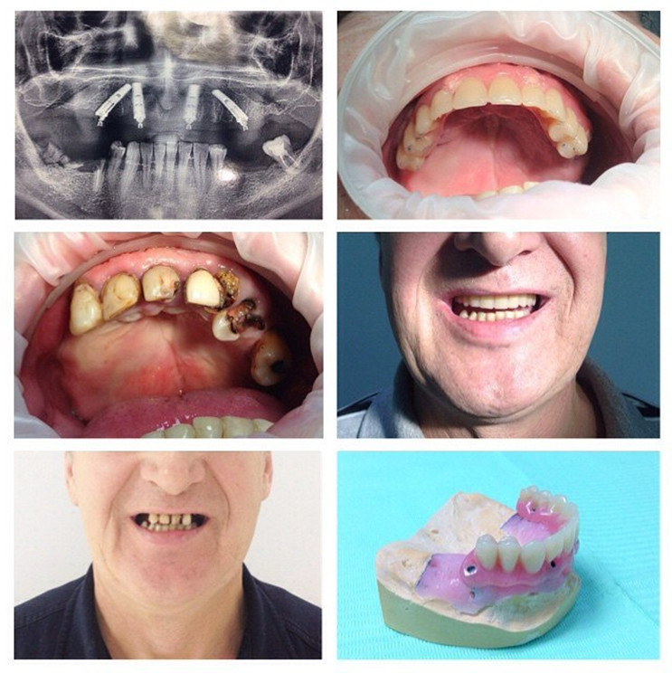 Протезирование зубов All-on-4