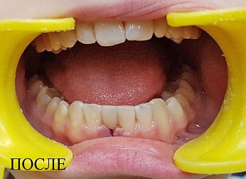 Удаление и реставрация зуба у подростка