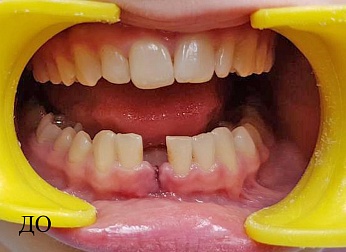 Удаление и реставрация зуба у подростка