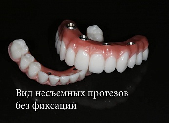 Протезирование зубов All-On-4