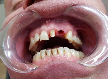 Удаление зуба и установка коронок