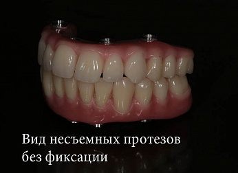 Протезирование зубов All-On-4