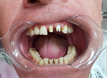 Удаление зуба и установка коронок